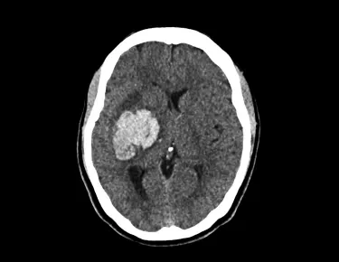 A computer tomography image of brain and skull showing large intracerebral hemorrhage