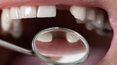 male patient with missing teeth examined by dentist