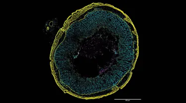 A colorful image shows a round cross-section of inflamed gut tissue. Tiny green squiggles represent C. diff cells where toxin genes are turned on throughout the tissue layers colored yellow or cyan. The magenta highlights the subset of C. diff that do not express the toxin genes.