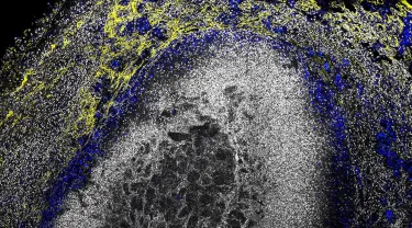 a microscopic view of a tuberculosis lesion