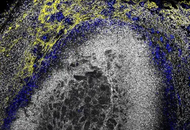 a microscopic view of a tuberculosis lesion
