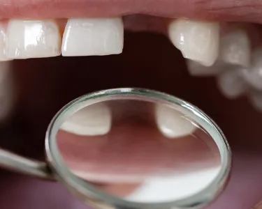 male patient with missing teeth examined by dentist