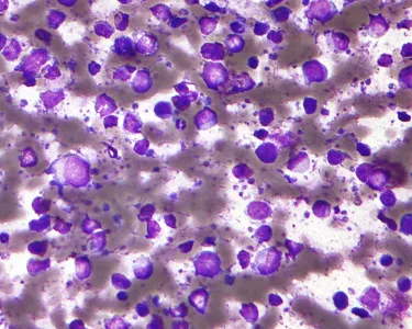 Magnified view of diffuse large B cell lymphoma in a lymph node sample